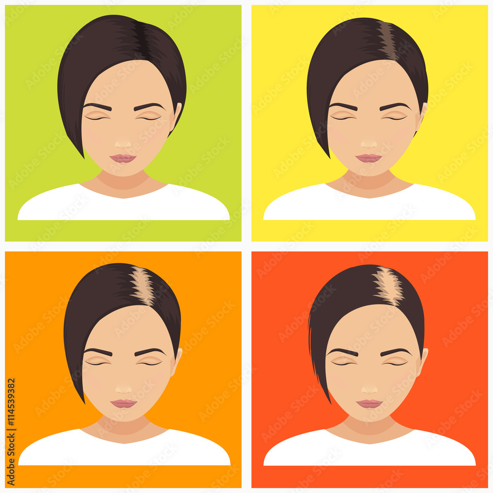 Female hair loss stages vector set on multicolored background. Female pattern baldness. Different stages of hair loss in women. Transplantation of hair. Human hair growth. Hair care concept. Stock Vector | Adobe Female hair loss stages vector set on multicolored background. Female pattern baldness. Different stages of hair loss in women. Transplantation of hair. Human hair growth. Hair care concept. Stock Vector | Adobe
