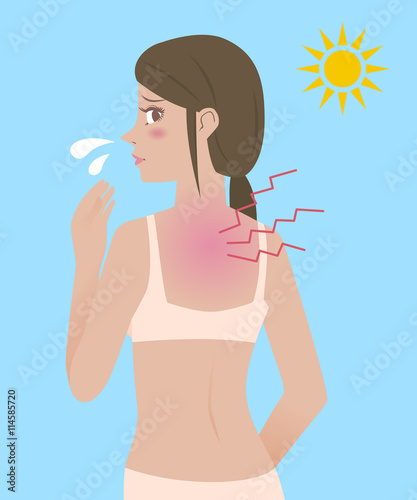young female with a bad sunburn on her back