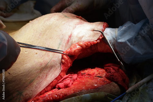 Surgeon detaches the skin with subcutaneous fat close-up photo