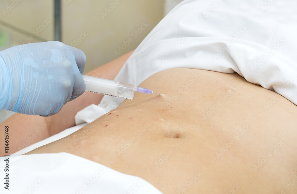woman is in the process cellulite mesotherapy clinic woman is in the process cellulite mesotherapy clinic