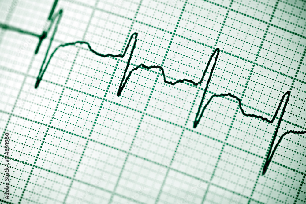Electrocardiogram Electrocardiogram