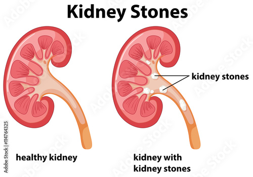 Diagram of kidney stones