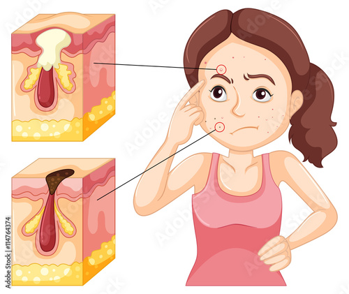 Woman having problem with pimples