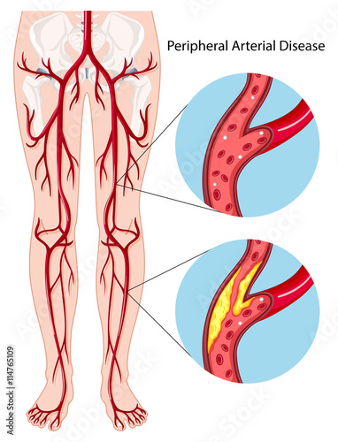 Peripheral arterial disease diagram