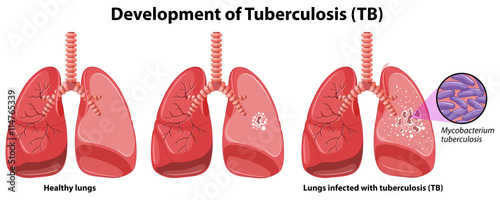 Chart showing development of tuberculosis photo
