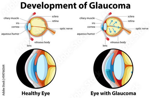 Diagram showing development of glaucoma