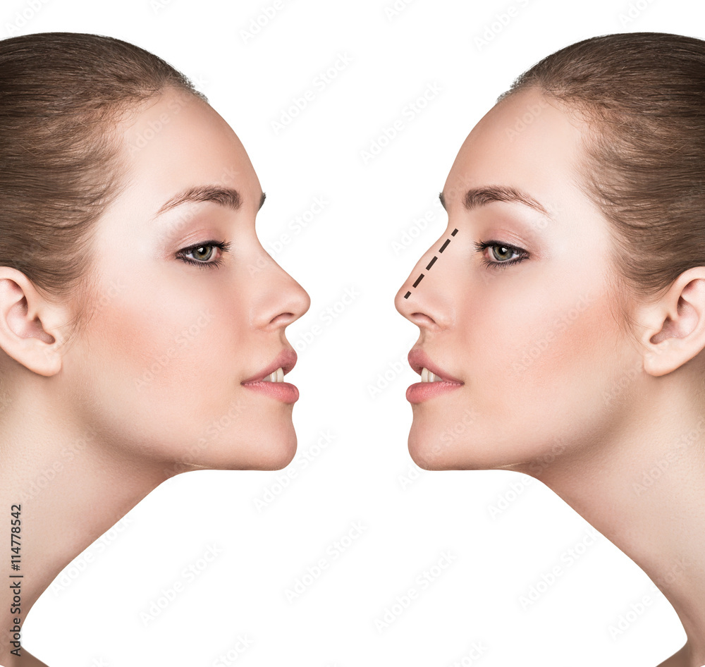 Naklejka premium Woman before and after cosmetic nose surgery