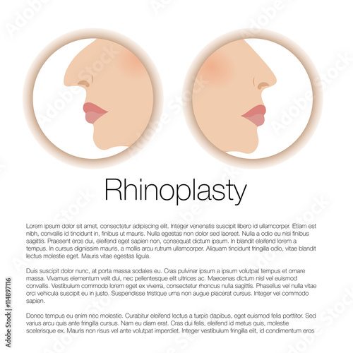illustration of rhinoplasty. cosmetic surgery. aesthetic medicine. vector