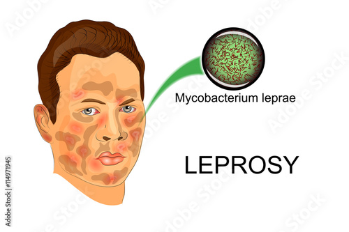 Photo the face of the patient suffering from leprosy