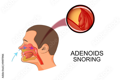 adenoids cause snoring photo