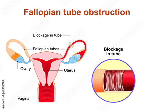 Fallopian tube obstruction