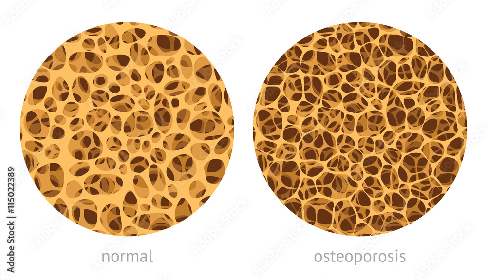 Bone spongy structure