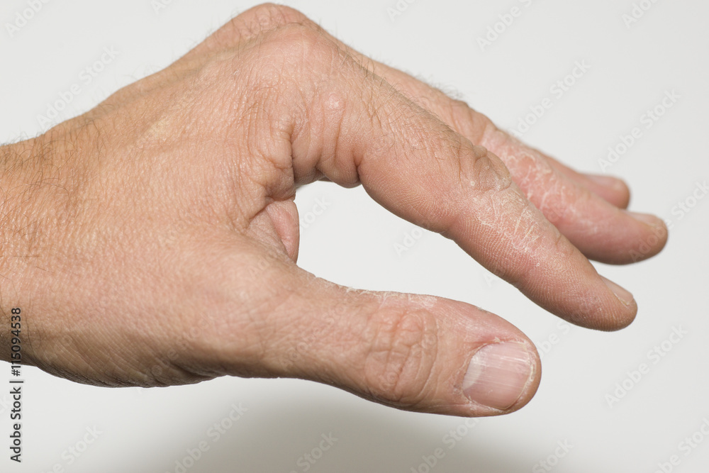 Wunschmotiv: Krankheitsverlauf Neurodermitis Hand seitlich freigestellt 654 #115094538