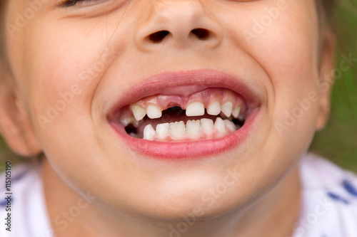 Little girl fell a baby tooth. Child's mouth with hole between the teeth. Shallow dept of field