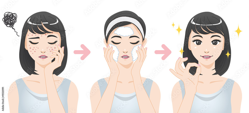Tableau sur toile acne treatment before after, facial cleansing foam, cartoon illustration