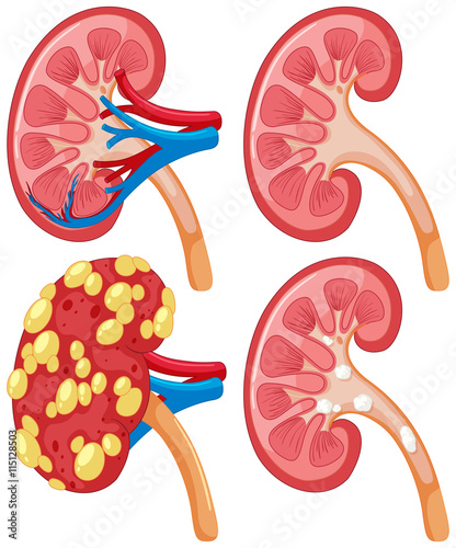 Diagram of kidney with disease
