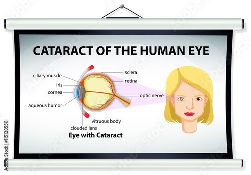 Chart showing cataract of human eye