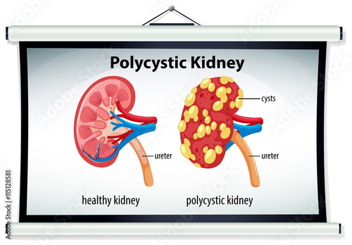 Diagram of polycystic kidney