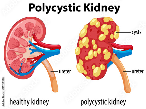 Diagram showing polycystic kidney