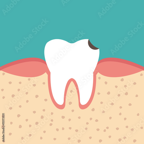 tooth sectional view tooth decay