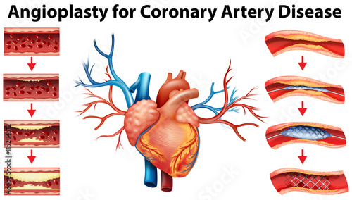 Diagram showing angioplasty for coronary artery disease photo