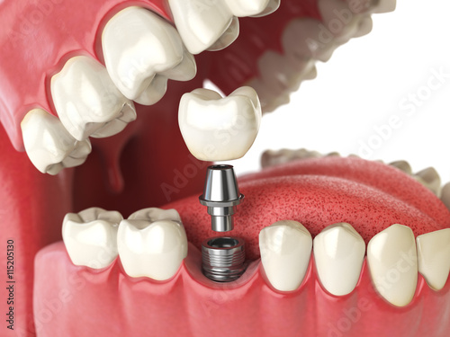 Tooth human implant. Dental concept. Human teeth or dentures. photo