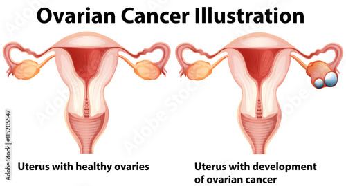 Healthy and unhealthy ovaries in woman