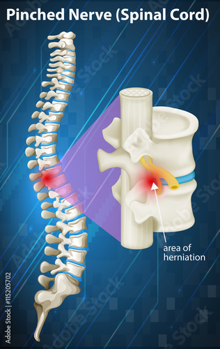 Diagram of pinched nerve at spinal cord