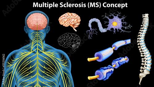 Diagram showing multiple sclerosis concept