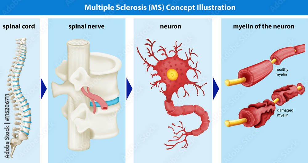 Diagram showing multiple sclerosis concept Stock Vector Adobe Stock