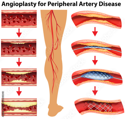 Diagram showing angioplasty for peripheral artery disease