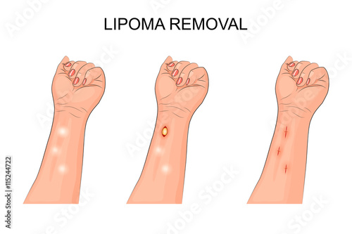 lipoma. removal of lipoma on forearm photo