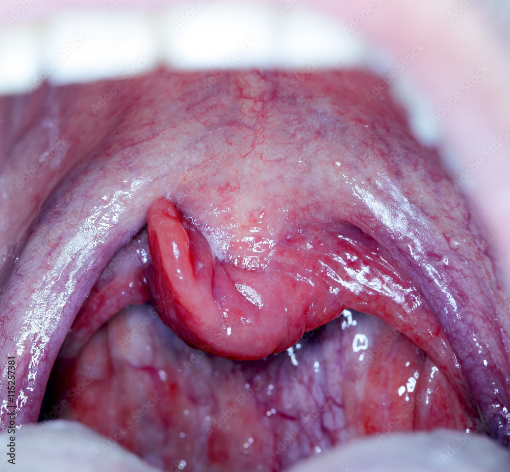 Fototapeta premium throat tonsil