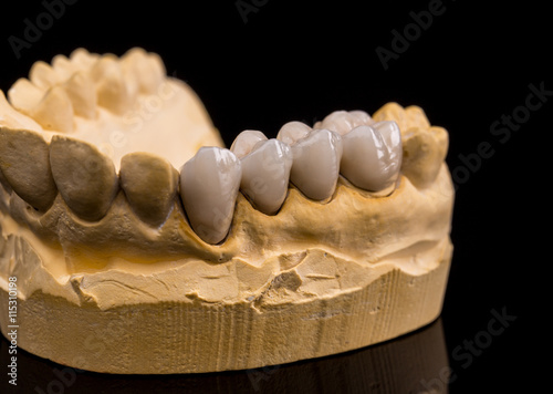 Ceramic dentures photo