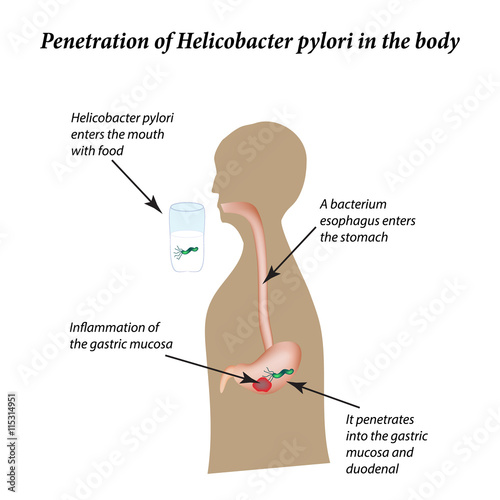 Infection with Helicobacter pylori. Infographics. Vector illustration on isolated background