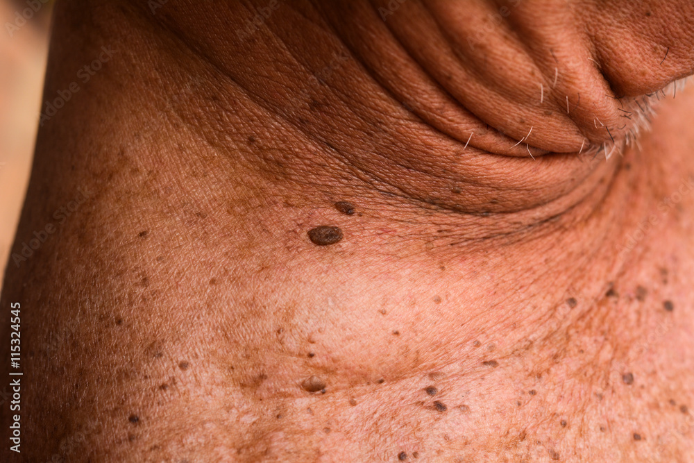Naklejka premium Moles on the body