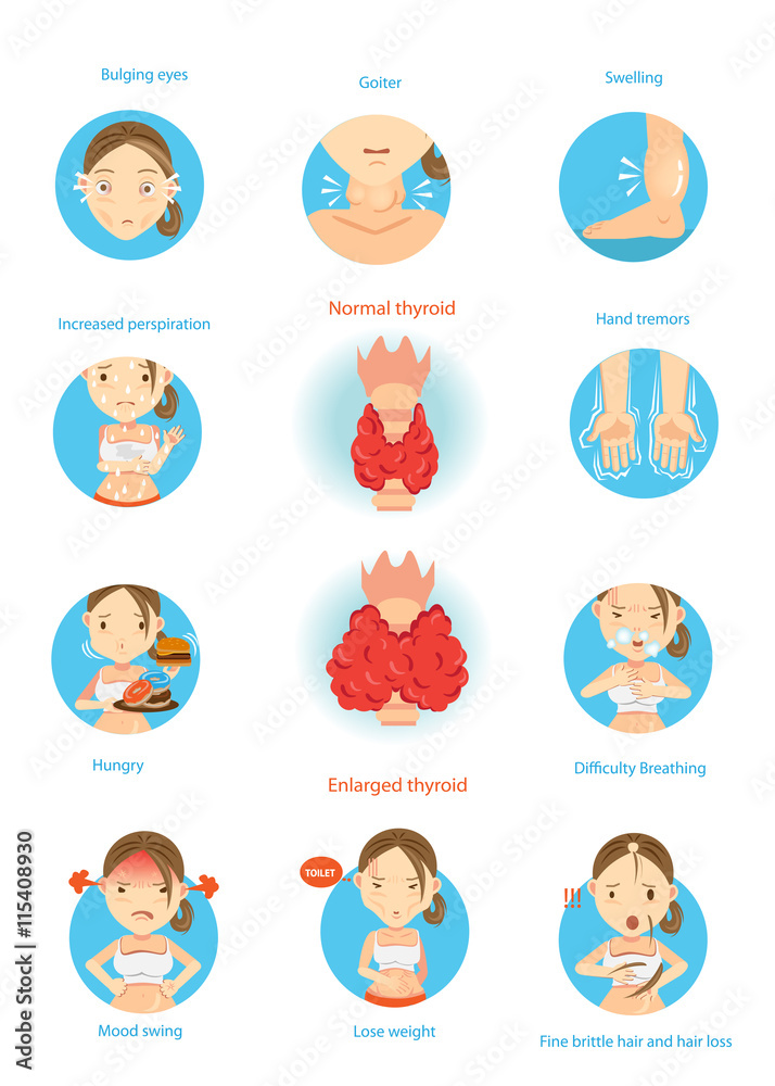 Hyperthyroidism/Symptoms of the disease hyperthyroidism illustrations