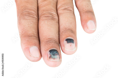 bruises on nail
