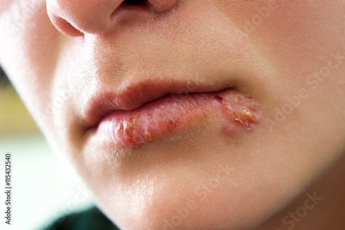 Oral herpes infection photo