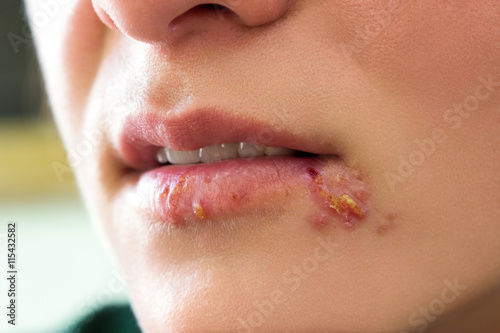 Herpes blisters photo