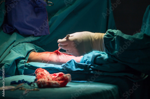 Surgery for Coronary Artery Bypass Grafting: CABG
