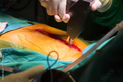 suture close sternotomy incision
