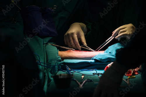 Surgery for Coronary Artery Bypass Grafting: CABG