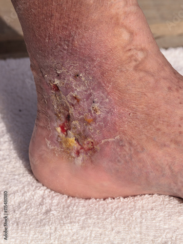 Medical picture: Infection cellulitis on the skin of an ankle caused by phlebitis and blood clots in the vein.  photo