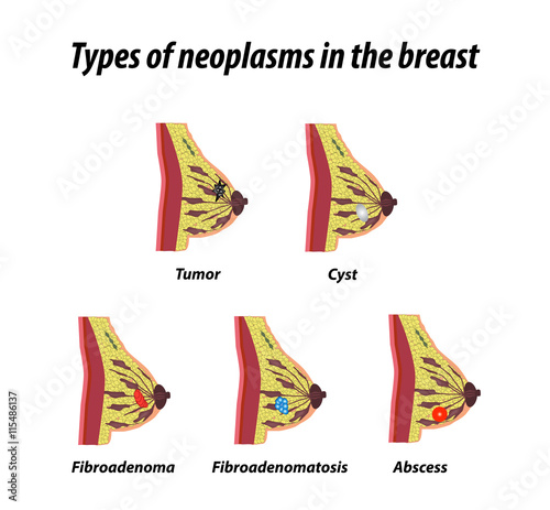 Types of neoplasms in the breast. Infographics. Set. Vector illustration on isolated background