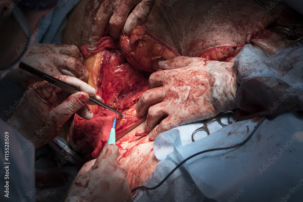Surgeon cauterizing vessels with coagulator and tweezers close-up
