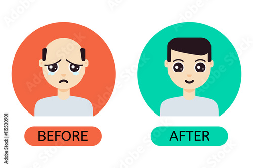 Man with hair loss problem before and after hair treatment and hair transplantation. Male hair loss set in cartoon style. Perfect for hair clinics and diagnostic centers. Vector illustration.

