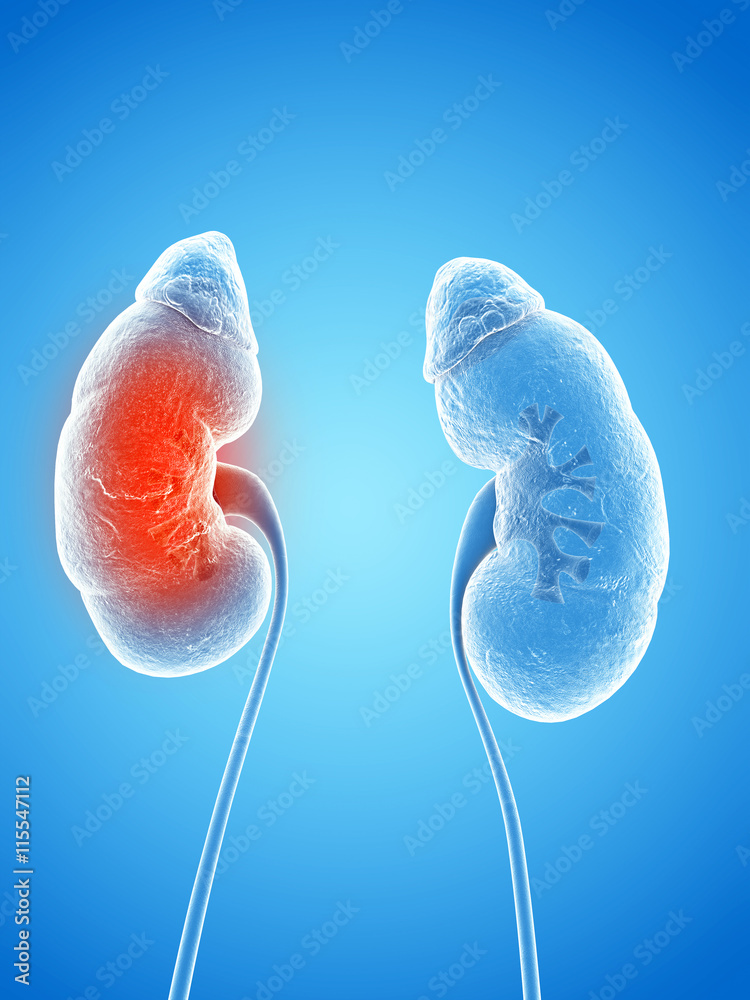 3d rendered illustration of an inflamed kidney 3d rendered illustration of an inflamed kidney