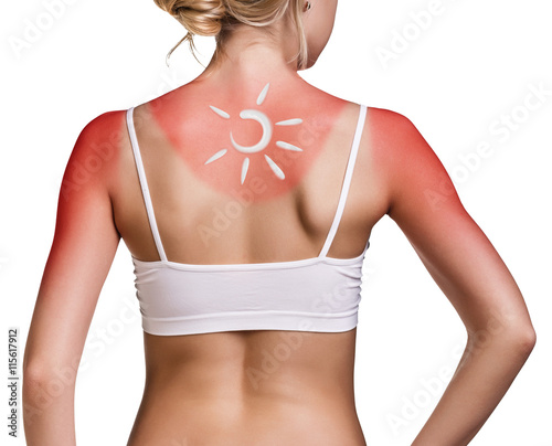 Canvas Print Cream on the shoulder of woman with sunburn