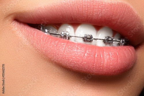 Beautiful macro shot of white teeth with braces. Dental care photo. Beauty woman smile with ortodontic accessories. Orthodontics treatment. Closeup of healthy female mouth